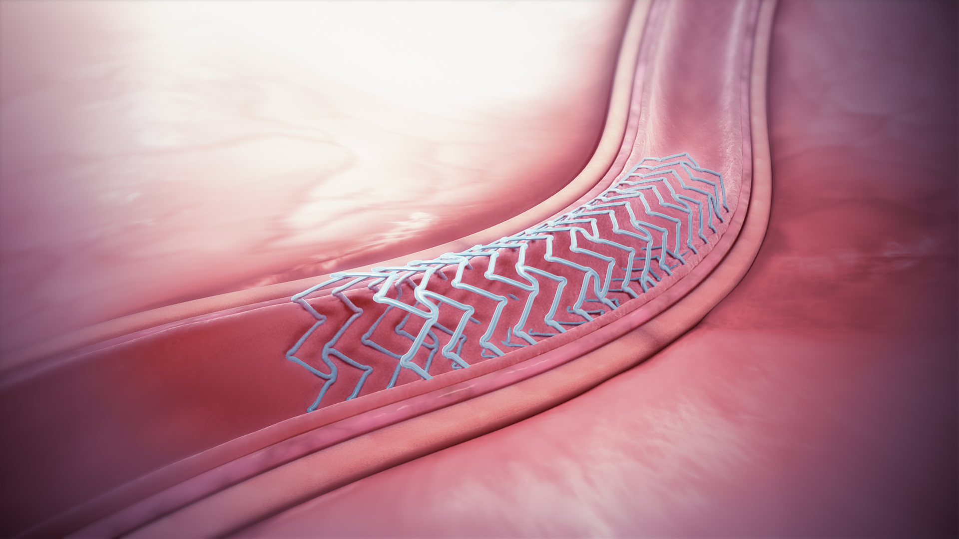 3. Phương pháp đặt Stent hiệu quả nhất