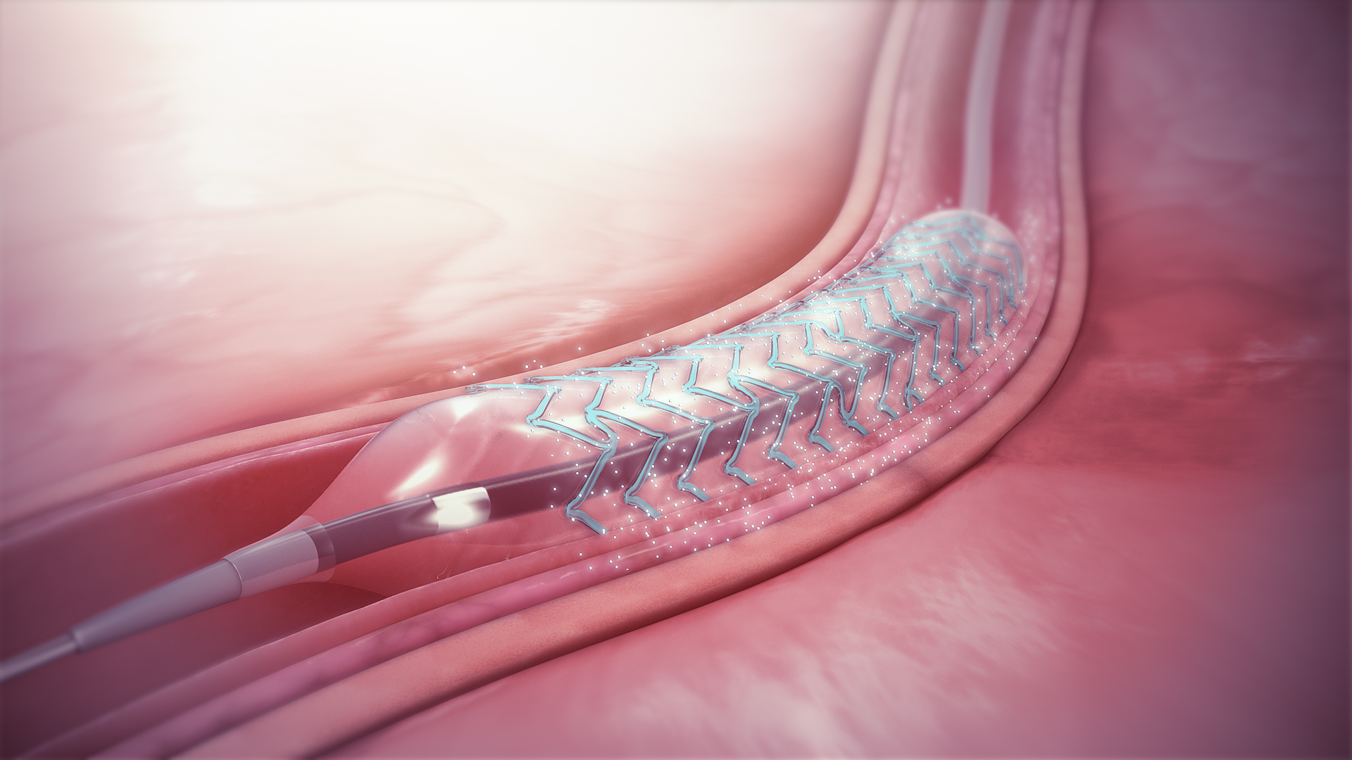 1. Làm thế nào để tìm hiểu về việc đặt stent?