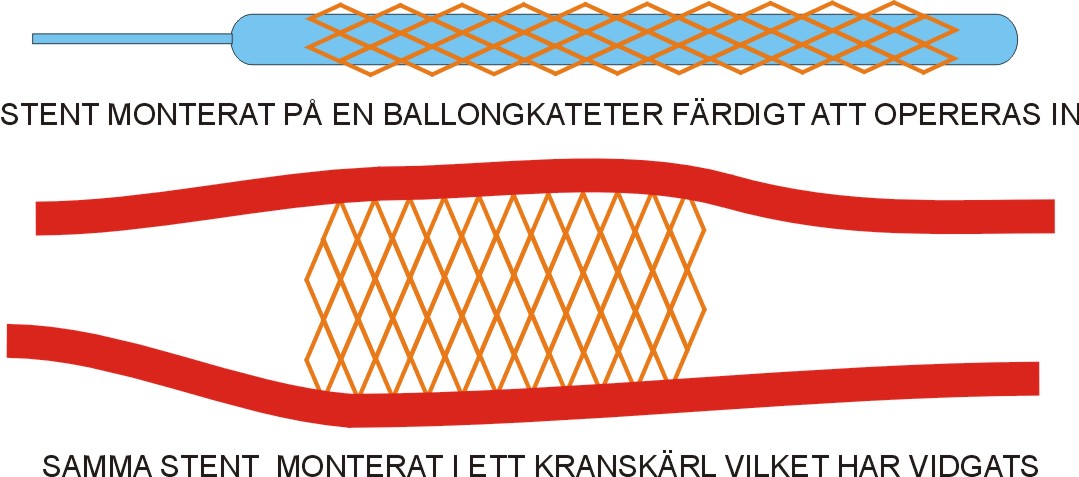 2. Ưu điểm và nhược điểm của việc đặt Stent